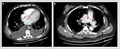 Prognostic value of right ventricular dilatation on computed tomography pulmonary angiogram for predicting adverse clinical events in severe COVID-19 pneumonia